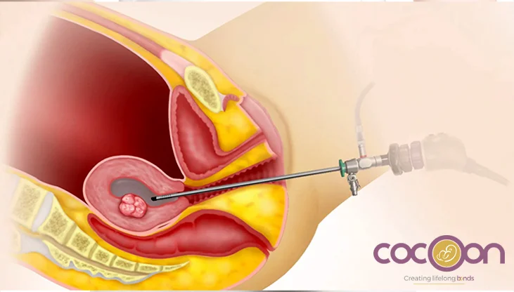 Hysteroscopy: A Minimally Invasive Procedure For Diagnosing Uterine Issues