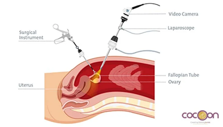Laparoscopy Surgery: Benefits, Recovery & How It Helps With Endometriosis