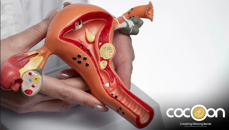 Can Ovarian Cysts Affect Fertility? Here’s What Experts Say